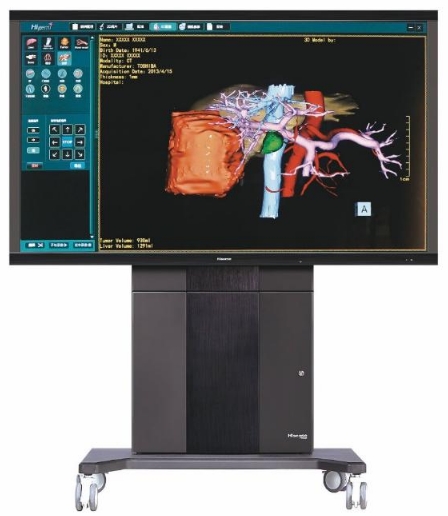 骨科手術(shù)的精確導(dǎo)航：計(jì)算機(jī)輔助手術(shù)（CAS）系統(tǒng)的作用