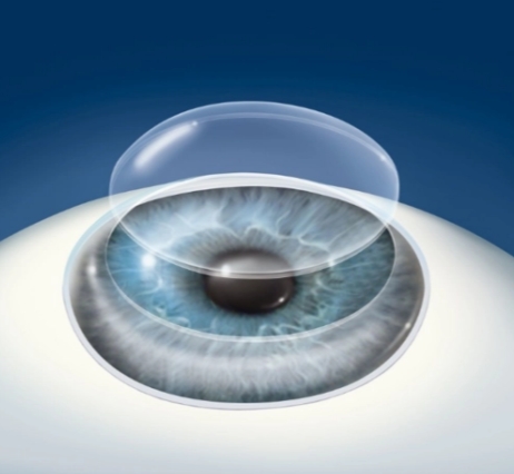 精準眼科手術的未來：飛秒激光角膜移植系統(tǒng)的臨床應用與價值