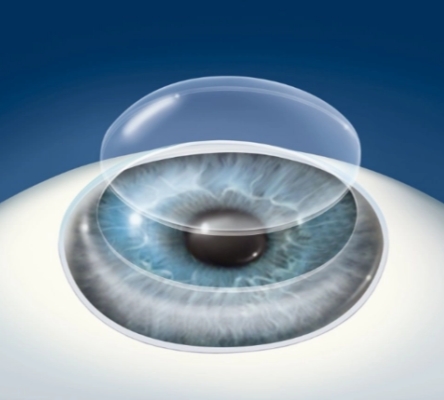 重塑視界：飛秒激光角膜手術讓清晰觸手可及