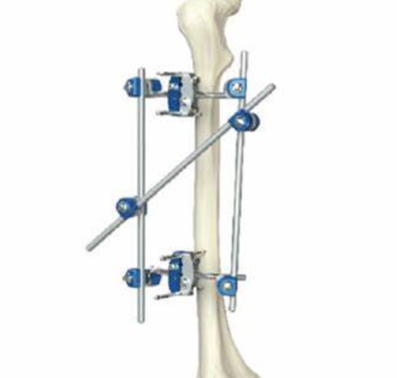 外固定支架：外部支撐，內(nèi)部修復(fù)——外固定支架在骨折治療中的作用