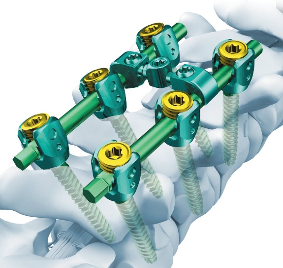 脊柱固定系統(tǒng)：穩(wěn)定脊柱，緩解疼痛——脊柱固定系統(tǒng)的設(shè)計(jì)與實(shí)施要點(diǎn)